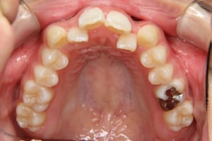 左右側切歯が口蓋側転位しています